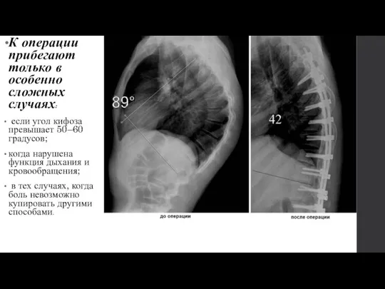 К операции прибегают только в особенно сложных случаях: если угол кифоза превышает