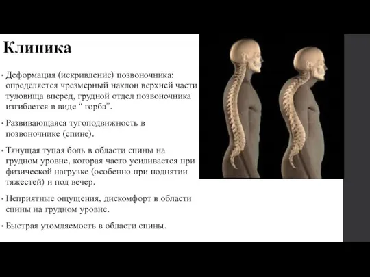 Клиника Деформация (искривление) позвоночника: определяется чрезмерный наклон верхней части туловища вперед, грудной