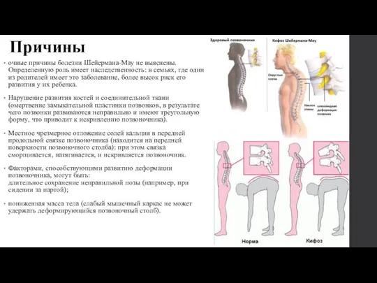 Причины очные причины болезни Шейермана-Мау не выяснены. Определенную роль имеет наследственность: в