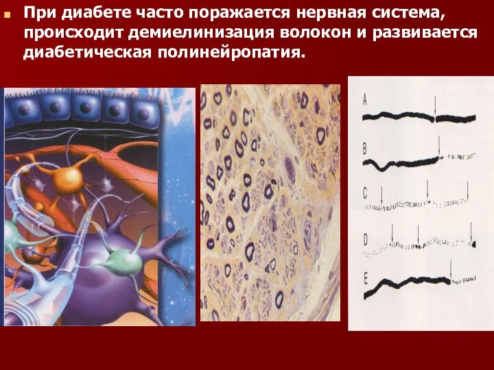 При диабете часто поражается нервная система, происходит демиелинизация волокон и развивается диабетическая полинейропатия.