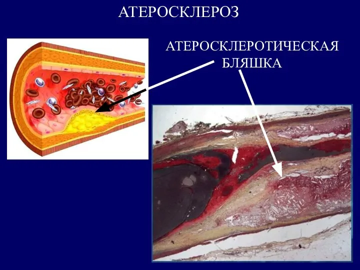 АТЕРОСКЛЕРОЗ АТЕРОСКЛЕРОТИЧЕСКАЯ БЛЯШКА