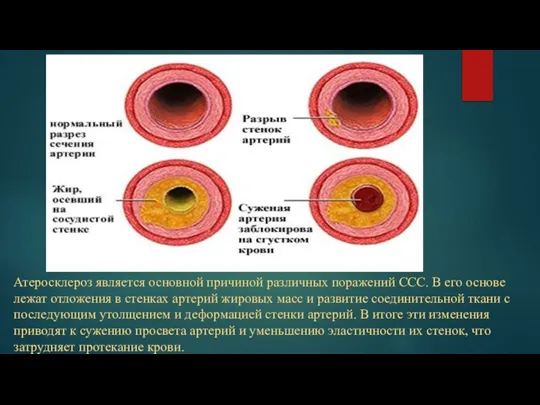 Атеросклероз является основной причиной различных поражений ССС. В его основе лежат отложения