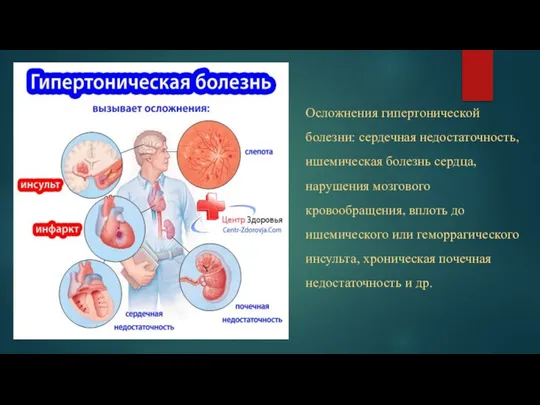 Осложнения гипертонической болезни: сердечная недостаточность, ишемическая болезнь сердца, нарушения мозгового кровообращения, вплоть