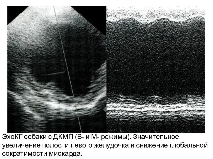 ЭхоКГ собаки с ДКМП (В- и М- режимы). Значительное увеличение полости левого