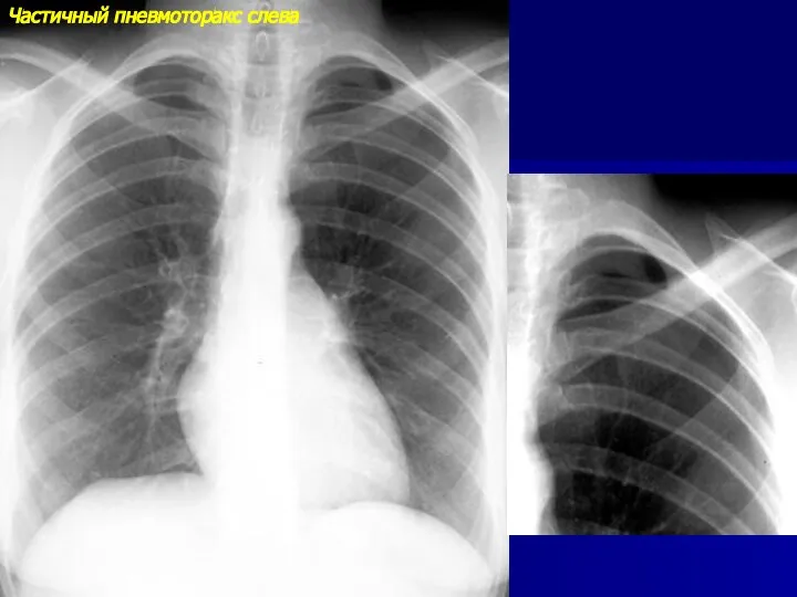 Частичный пневмоторакс слева