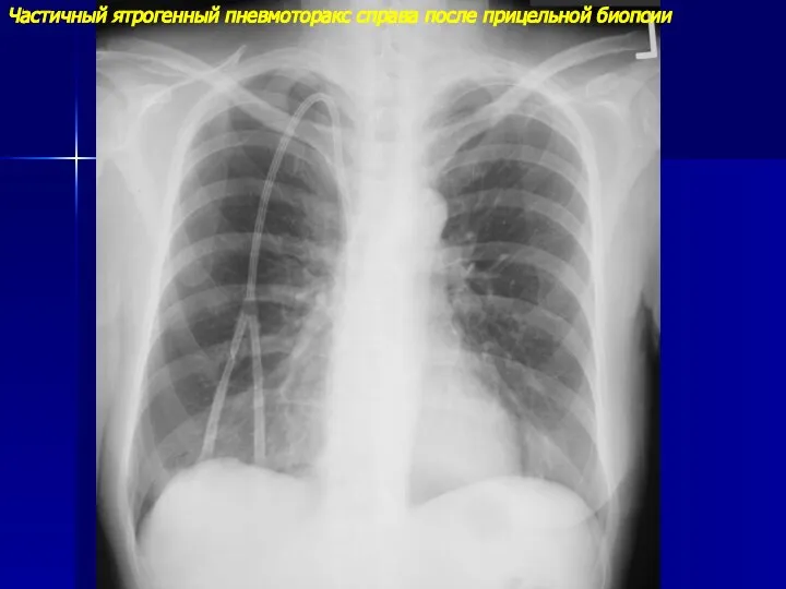 Частичный ятрогенный пневмоторакс справа после прицельной биопсии