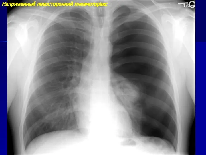 Напряженный левосторонний пневмоторакс