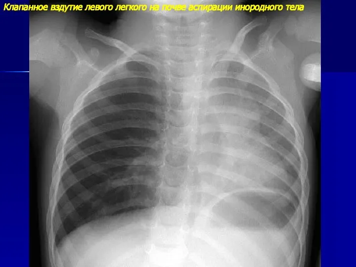Клапанное вздутие левого легкого на почве аспирации инородного тела