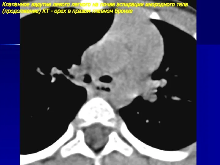 Клапанное вздутие левого легкого на почве аспирации инородного тела (продолжение) КТ -