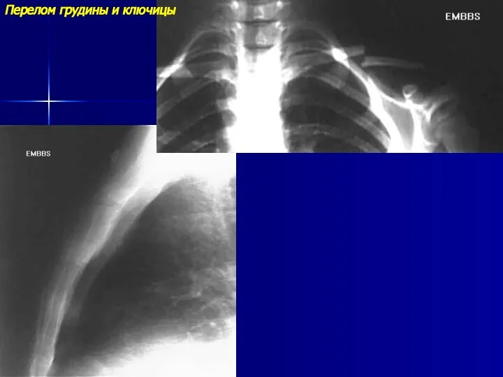 Перелом грудины и ключицы