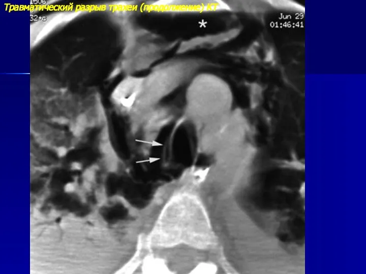 Травматический разрыв трахеи (продолжение) КТ