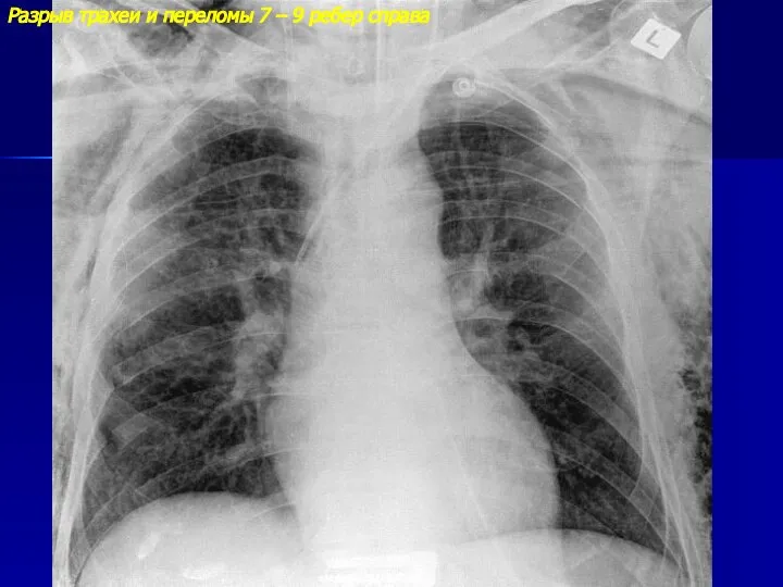 Разрыв трахеи и переломы 7 – 9 ребер справа