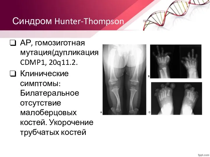 Синдром Hunter-Thompson АР, гомозиготная мутация(дупликация) CDMP1, 20q11.2. Клинические симптомы: Билатеральное отсутствие малоберцовых костей. Укорочение трубчатых костей