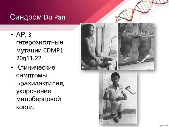 Синдром Du Pan АР, 3 гетерозиготные мутации CDMP1, 20q11.22. Клинические симптомы: Брахидактилия, укорочение малоберцовой кости.