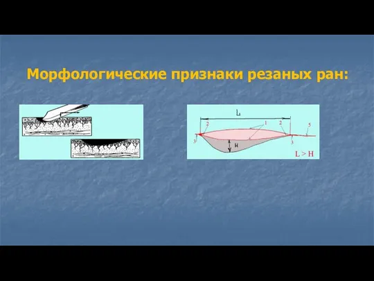 Морфологические признаки резаных ран: