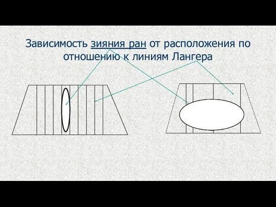 Зависимость зияния ран от расположения по отношению к линиям Лангера