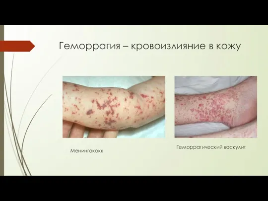 Геморрагия – кровоизлияние в кожу Менингококк Геморрагический васкулит