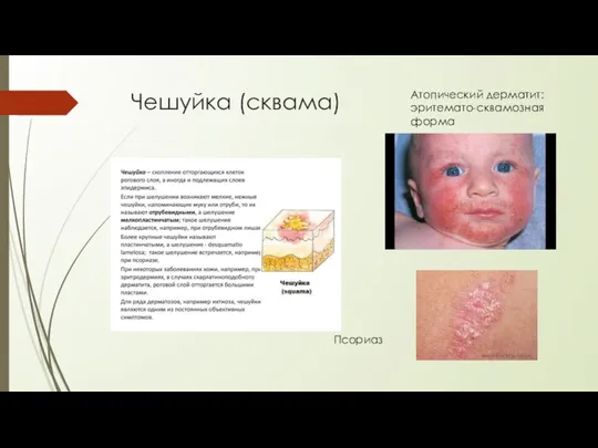 Чешуйка (сквама) Псориаз Атопический дерматит: эритемато-сквамозная форма