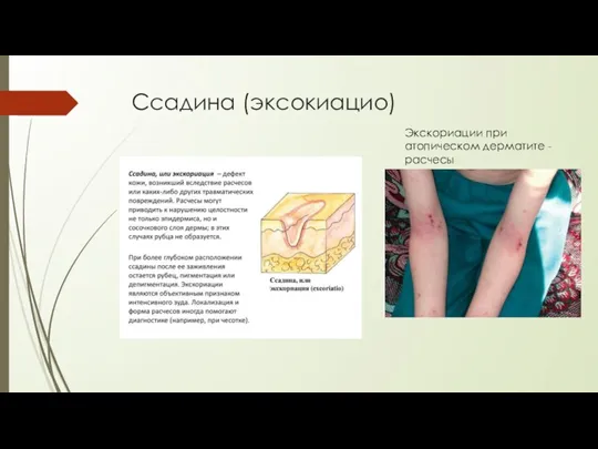 Ссадина (эксокиацио) Экскориации при атопическом дерматите - расчесы