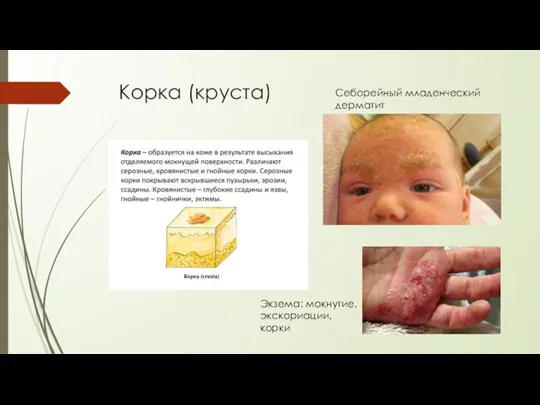 Корка (круста) Себорейный младенческий дерматит Экзема: мокнутие, экскориации, корки