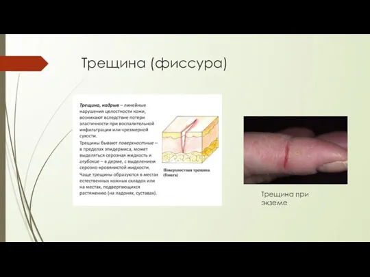 Трещина (фиссура) Трещина при экземе