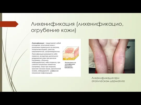 Лихенификация (лихенификацио, огрубение кожи) Лихенификация при атопическом дерматите