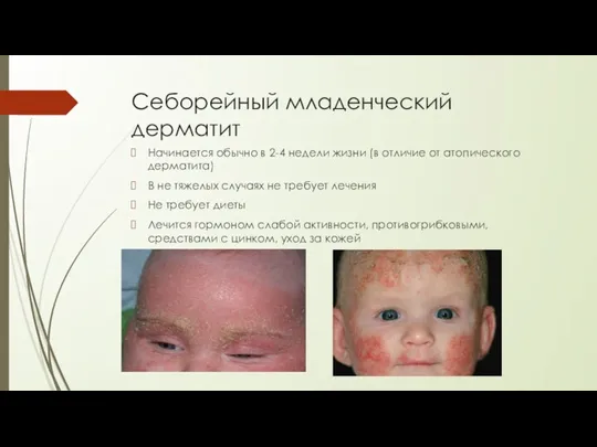 Себорейный младенческий дерматит Начинается обычно в 2-4 недели жизни (в отличие от