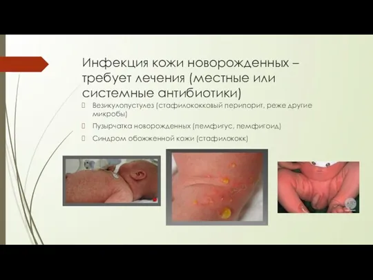 Инфекция кожи новорожденных – требует лечения (местные или системные антибиотики) Везикулопустулез (стафилококковый