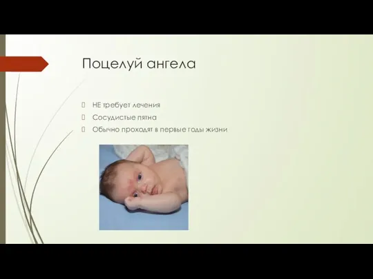 Поцелуй ангела НЕ требует лечения Сосудистые пятна Обычно проходят в первые годы жизни