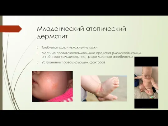 Младенческий атопический дерматит Требуется уход и увлажнение кожи Местные противовоспалительные средства (глюкокортикоиды,