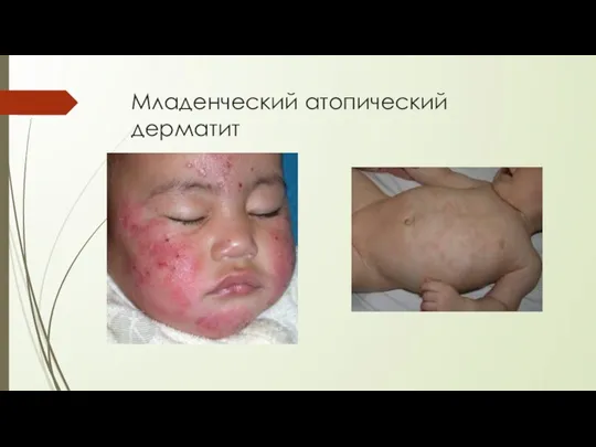 Младенческий атопический дерматит