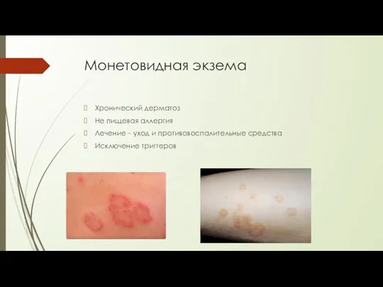 Монетовидная экзема Хронический дерматоз Не пищевая аллергия Лечение – уход и противовоспалительные средства Исключение триггеров