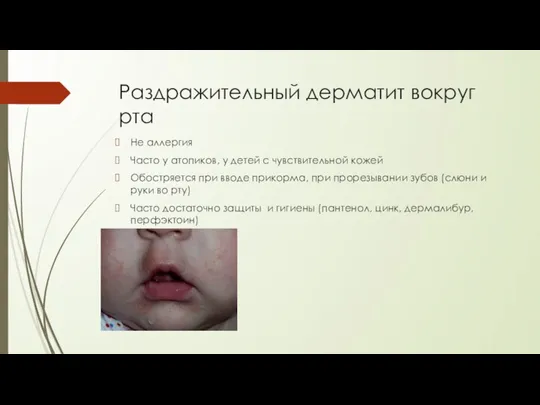 Раздражительный дерматит вокруг рта Не аллергия Часто у атопиков, у детей с