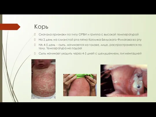 Корь Сначала признаки по типу ОРВИ и гриппа с высокой температурой На