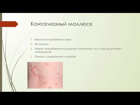 Контагиозный моллюск Вирусное поражение кожи НЕ опасно Может потребоваться удаление элементов, если