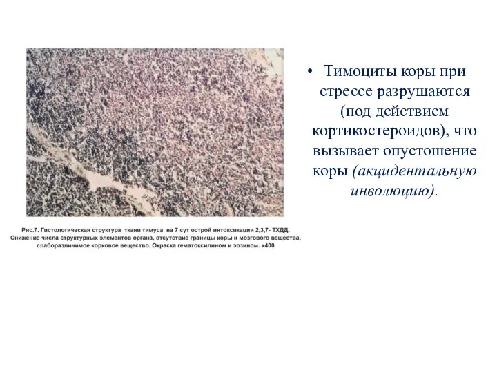 Тимоциты коры при стрессе разрушаются (под действием кортикостероидов), что вызывает опустошение коры (акцидентальную инволюцию).
