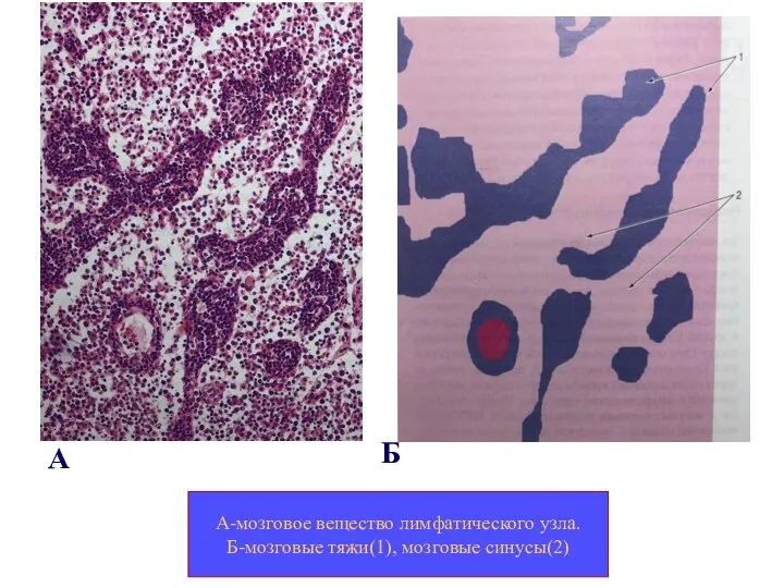 А-мозговое вещество лимфатического узла. Б-мозговые тяжи(1), мозговые синусы(2) А Б