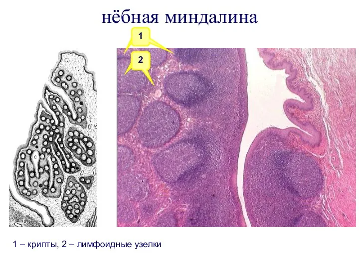 нёбная миндалина 1 1 2 1 1 – крипты, 2 – лимфоидные узелки