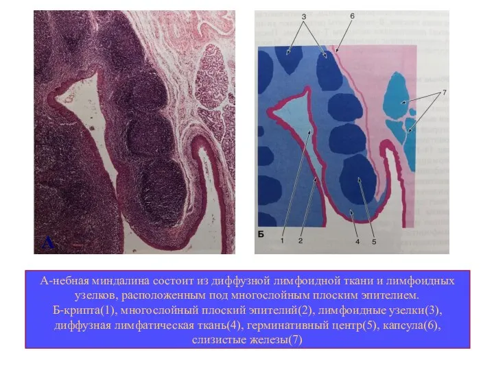 А-небная миндалина состоит из диффузной лимфоидной ткани и лимфоидных узелков, расположенным под