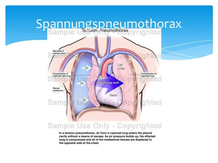 Spannungspneumothorax
