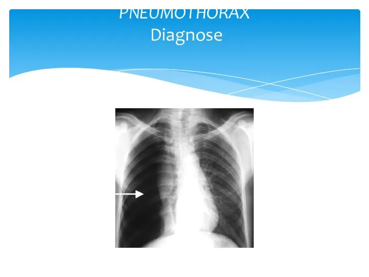 PNEUMOTHORAX Diagnose