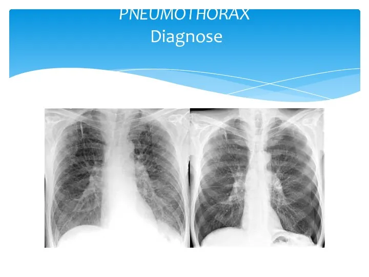 PNEUMOTHORAX Diagnose