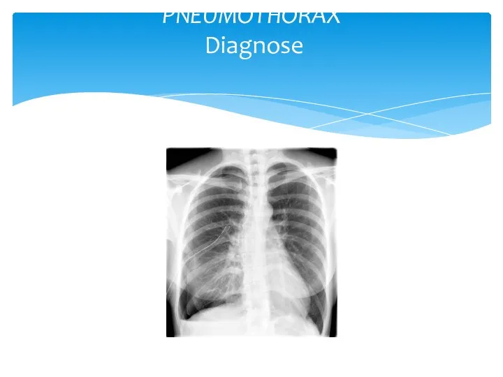 PNEUMOTHORAX Diagnose