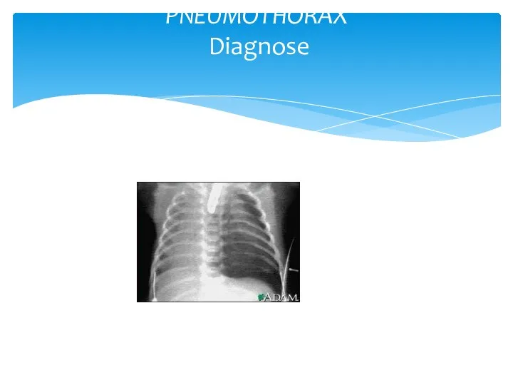 PNEUMOTHORAX Diagnose