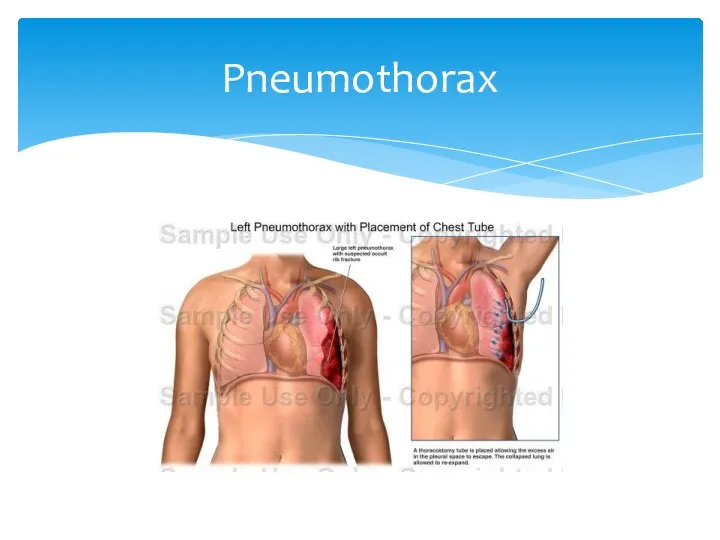 Pneumothorax