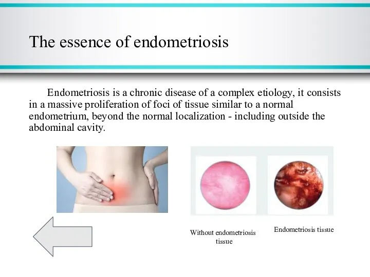 The essence of endometriosis Endometriosis is a chronic disease of a complex