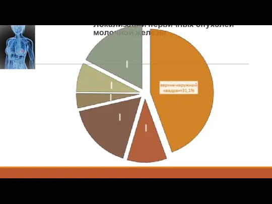 Локализации первичных опухолей молочной железы