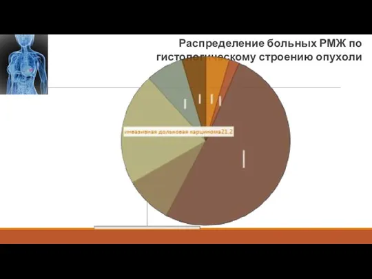 Распределение больных РМЖ по гистологическому строению опухоли