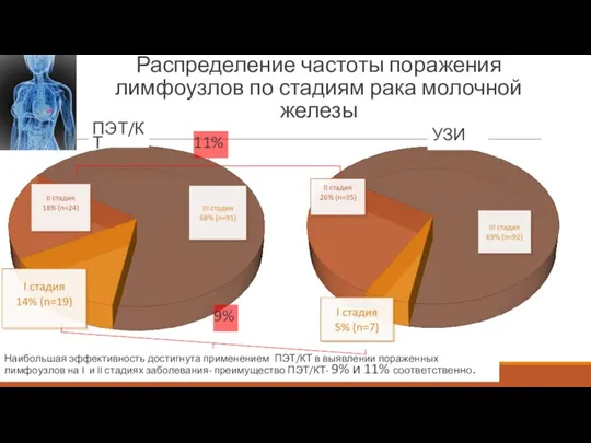 Распределение частоты поражения лимфоузлов по стадиям рака молочной железы Наибольшая эффективность достигнута