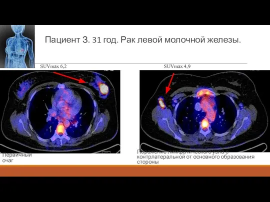 Пациент З. 31 год. Рак левой молочной железы. SUVmax 6,2 Поражение лимфатического